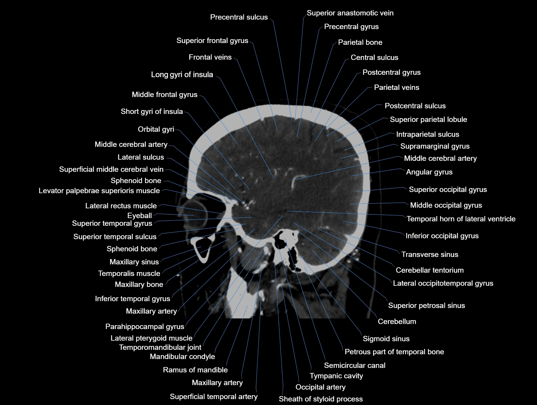 CT scan brain sagittal cross sectional anatomy image-img-00001-00021.webp